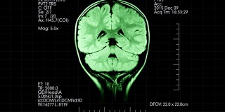 MRI俯视图绿色脑部扫描医学显示附加数据动画
