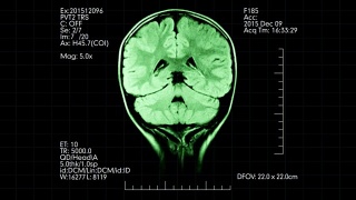 MRI俯视图绿色脑部扫描医学显示附加数据动画视频素材模板下载