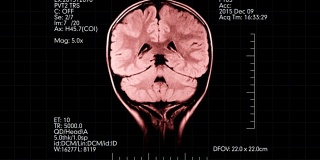MRI脑部扫描粉红色医学显示动画