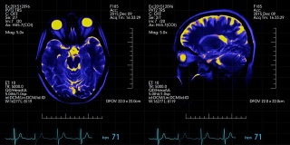 MRI大脑扫描未来显示蓝色和橙色与心率监视器