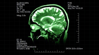绿色侧视图MRI脑部扫描显示动态医疗数据视频素材模板下载