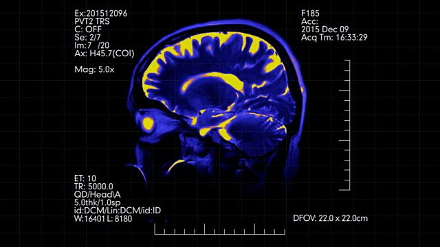双色蓝色和橙色侧视图mri大脑扫描与医学数据显示动画