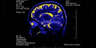 双色蓝色和橙色侧视图mri大脑扫描与医学数据显示动画