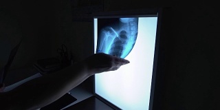 医生看了x光片。图像显示了锁骨、肋骨和肺。用骨内支架治疗骨折的过程。一个黑暗的房间