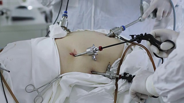 4K腹腔镜下腹部手术。
