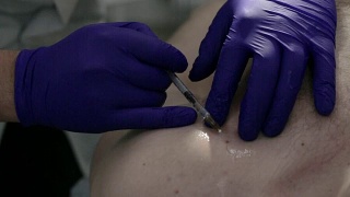 手术切除胎记前，医生在胎记周围注射局麻药视频素材模板下载