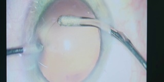干预中的眼科手术工具