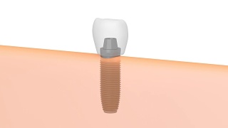 3D种植牙/种植牙视频素材模板下载