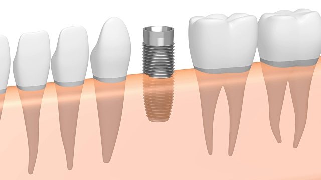 3D种植牙/种植牙
