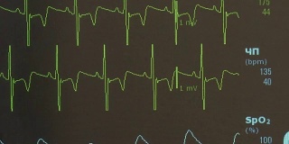 术中心律不齐的心电图和脉搏图像。