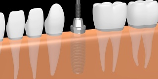 3D种植牙/种植牙