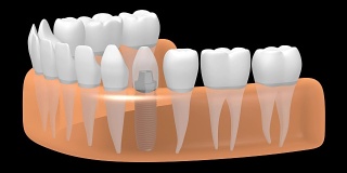 3D种植牙/种植牙