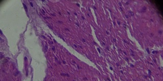 胃腺癌(管状腺癌)光镜下不同区域变焦