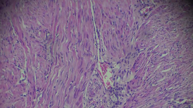 子宫内膜癌生物标本在不同范围的显微镜放大