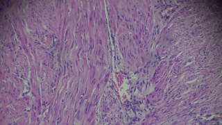 子宫内膜癌生物标本在不同范围的显微镜放大视频素材模板下载