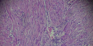 子宫内膜癌生物标本在不同范围的显微镜放大