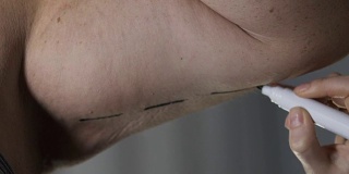 特写:整形外科医生的手在男性手臂上画线，这是体重减轻的结果