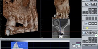 医生正在检查3D牙科扫描为未来种植
