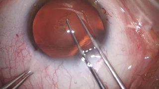 白内障眼科手术视频素材模板下载