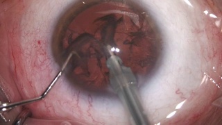 白内障眼科手术视频素材模板下载