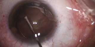 白内障眼科手术