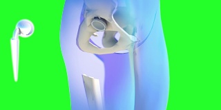 髋关节置换植入物安装在骨盆骨。医学精准3D动画