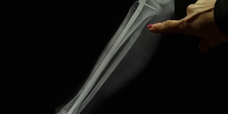 放射科医生用钛棒x光片显示骨折的腿