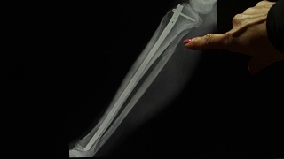 放射科医生用钛棒x光片显示骨折的腿视频素材模板下载