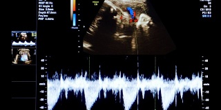HD -医疗超声扫描。心率诊断