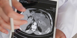 医生正在展示腹腔计算机断层扫描