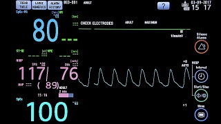 手术室心脏监护仪的关闭。心电监护仪显示患者的心率背景视频素材模板下载