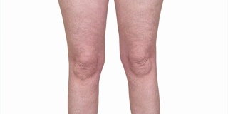 腿部脂肪堆积前后的对比