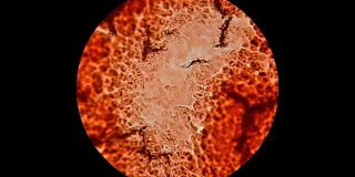 在显微镜下凝固干燥的血液