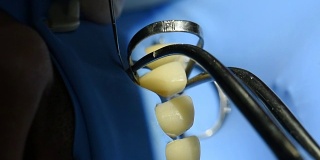 牙科柜中牙齿的近景。