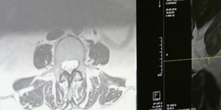 MRI上的脊髓和脊柱断层扫描。