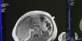 MRI脑部断层扫描。
