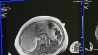 MRI脑部断层扫描。视频素材模板下载