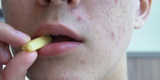 一个脸上长了青春痘的年轻人吃薯条。